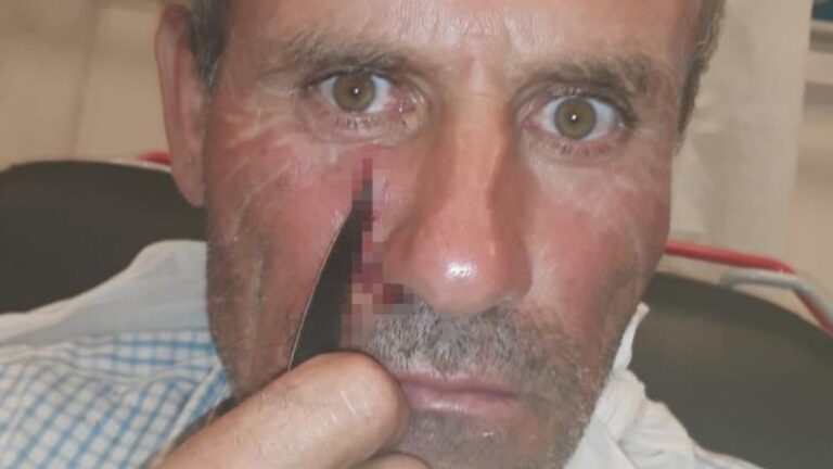 Denizli’de ayçiçeği tarlasında çalışan işçinin yüzüne bıçak saplandı