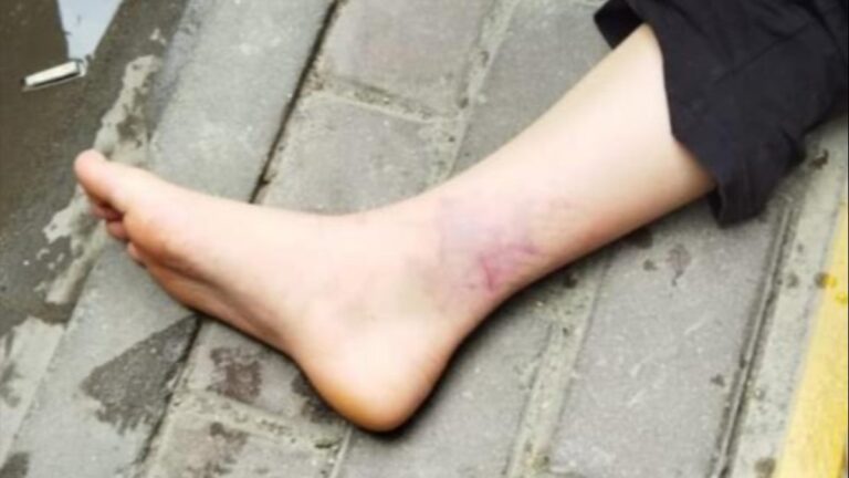 Kastamonu’da sokak köpeğinden kaçan kızın ayağını otomobil ezdi