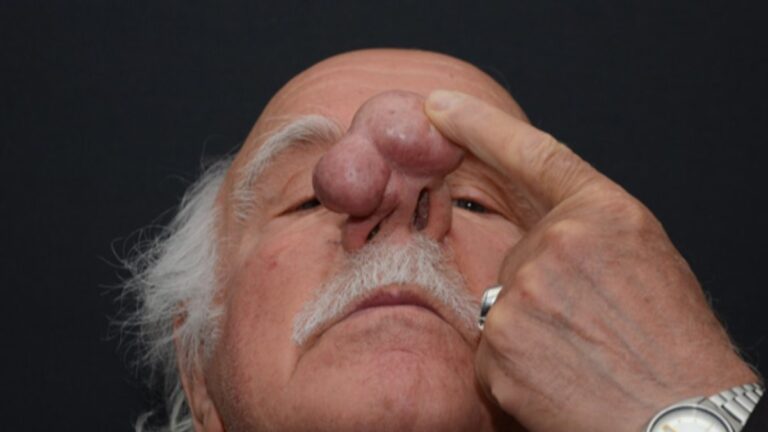 Trabzon’da burnundaki dev kitleyle 2 yıl yaşayan hasta ameliyatla kurtuldu